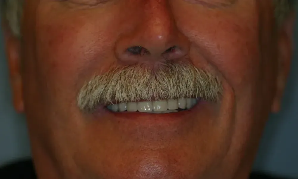 Clinical photo from Ron's dental implant case